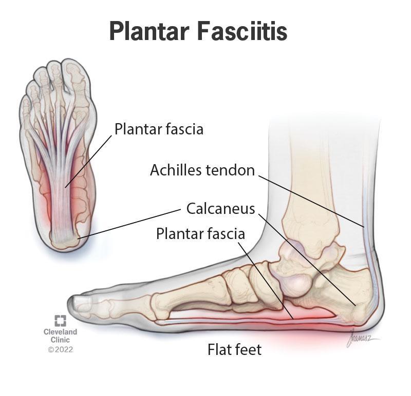 Best Shoes for Plantar Fasciitis Malaysia | Foot Pain Relief Guide